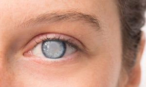 Chirurgie laser yeux effets secondaires